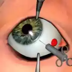 眼科手术最新版
